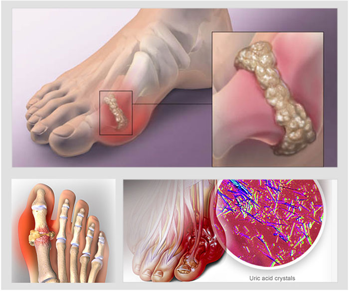 Nguyên nhân của bệnh Gout