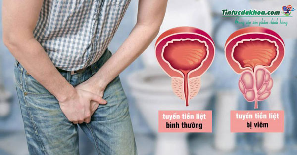 Viêm tuyến tiền liệt là bệnh thế nào?