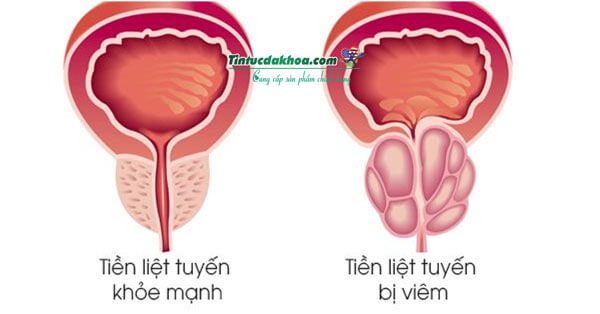 Dấu hiệu của bệnh viêm tuyến tiền liệt ở nam giới